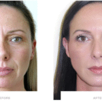 How a Botox Clinic Plans Natural Results