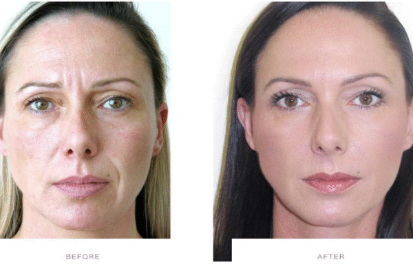 How a Botox Clinic Plans Natural Results
