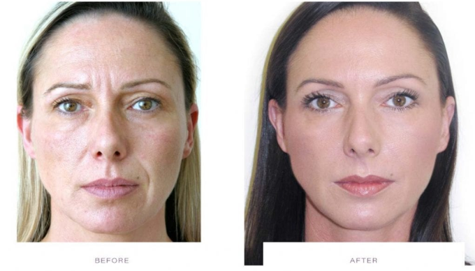How a Botox Clinic Plans Natural Results